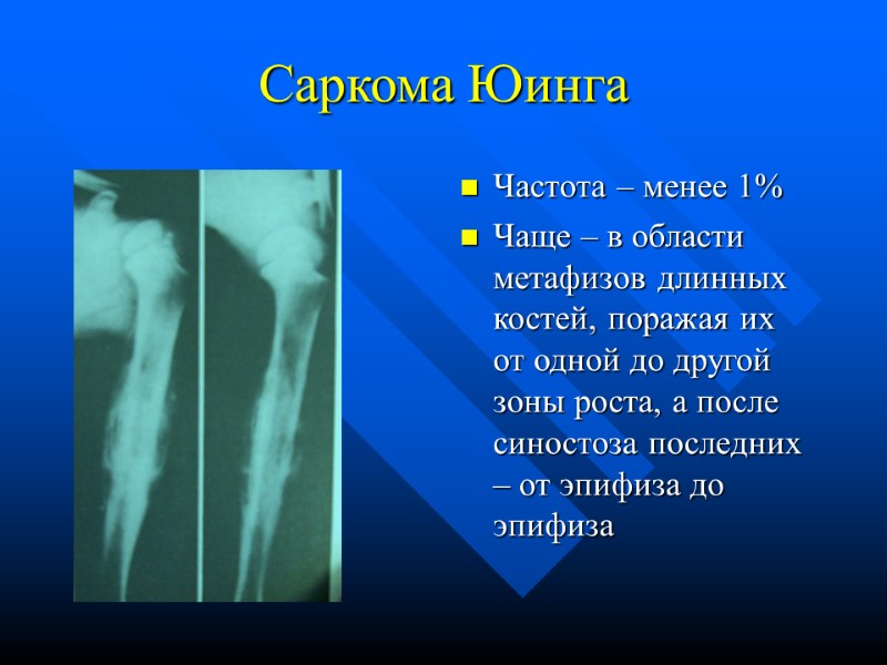 Саркома Юинга Частота – менее 1% Чаще – в области метафизов длинных костей, поражая